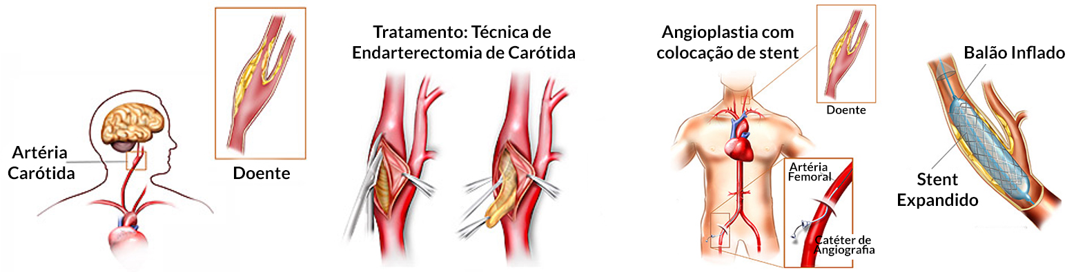 Doença Das Carótidas Uma Causa De Avc Eco Medical Center Cartaxo 6232